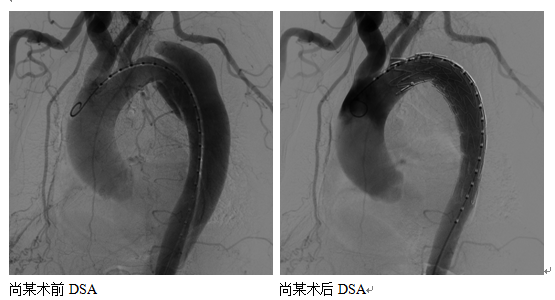 人医专家一天之内解除三枚“心脏炸弹”